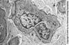 Alport-Syndrom (hereditäre Nephritis)