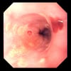 Herpes Simplex Esophagitis