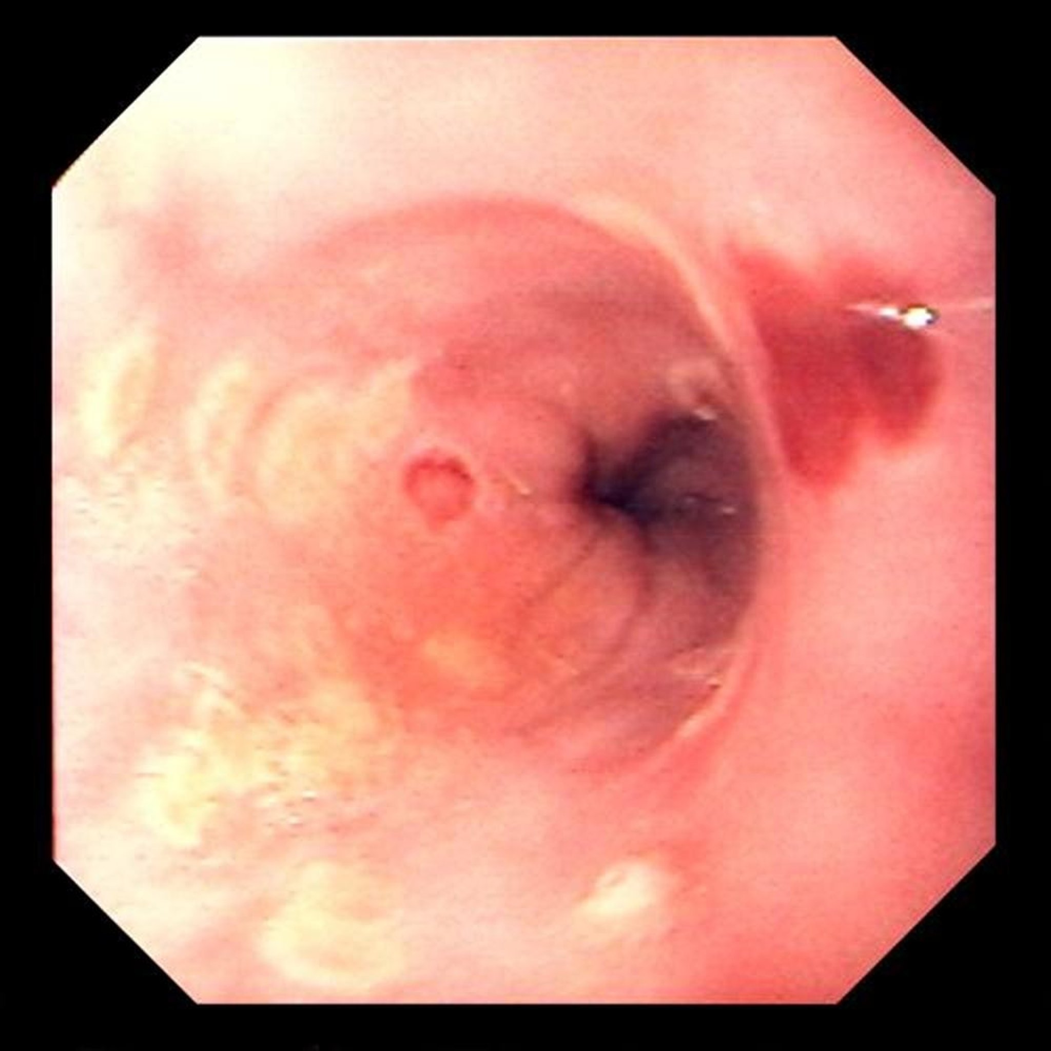 Herpes Simplex Esophagitis