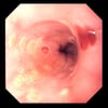 Esofagitis por herpes simple