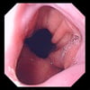 Hiatus Hernia