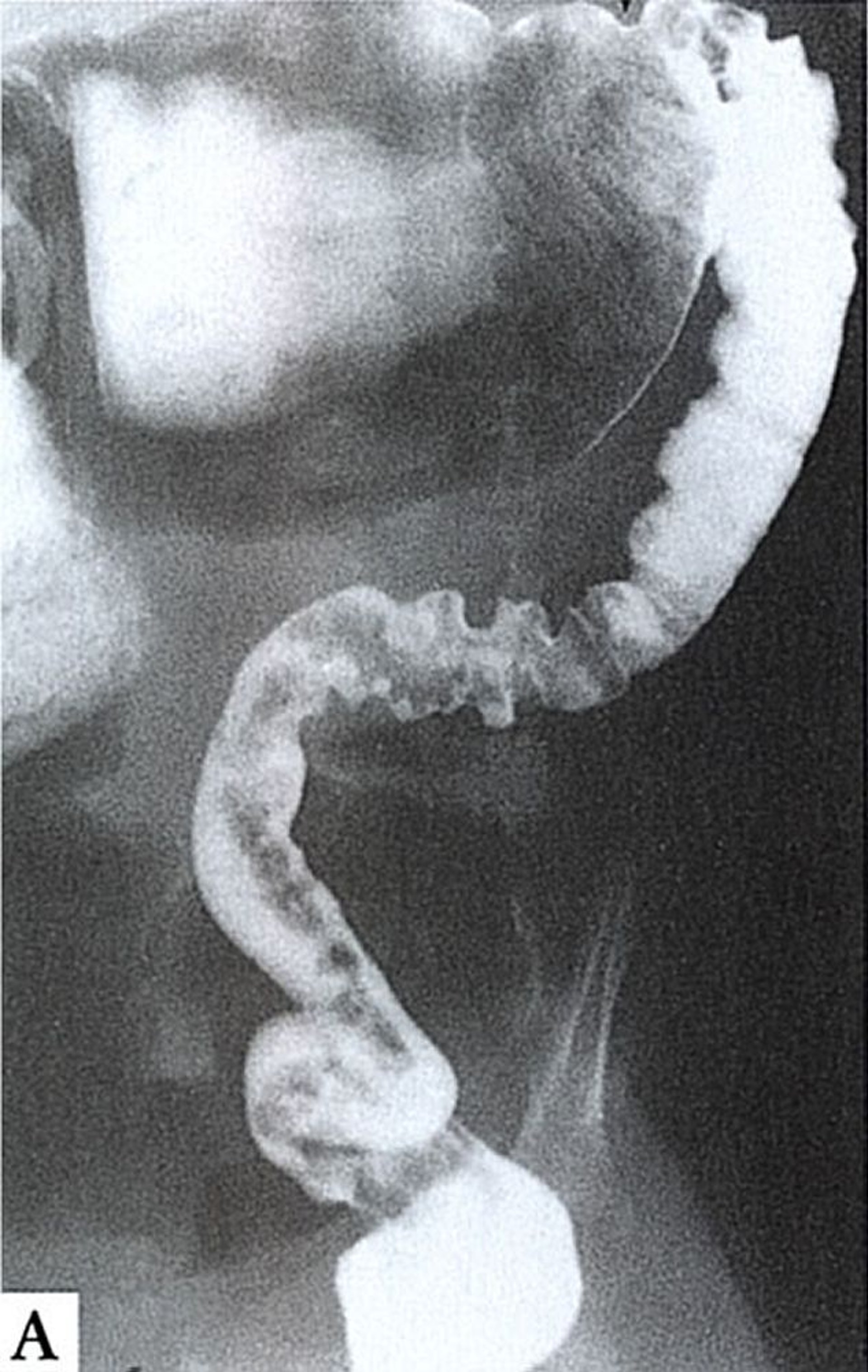 Malattia di Hirschsprung