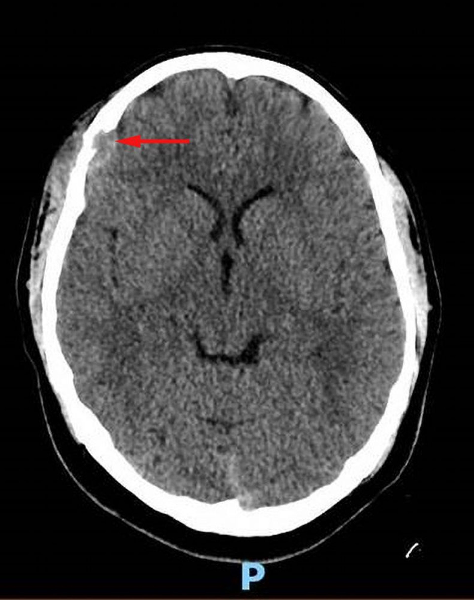 Histiocytose à cellules de Langerhans (TDM de la tête)