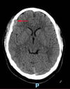 Istiocitosi a cellule di Langerhans (TC dell'encefalo)