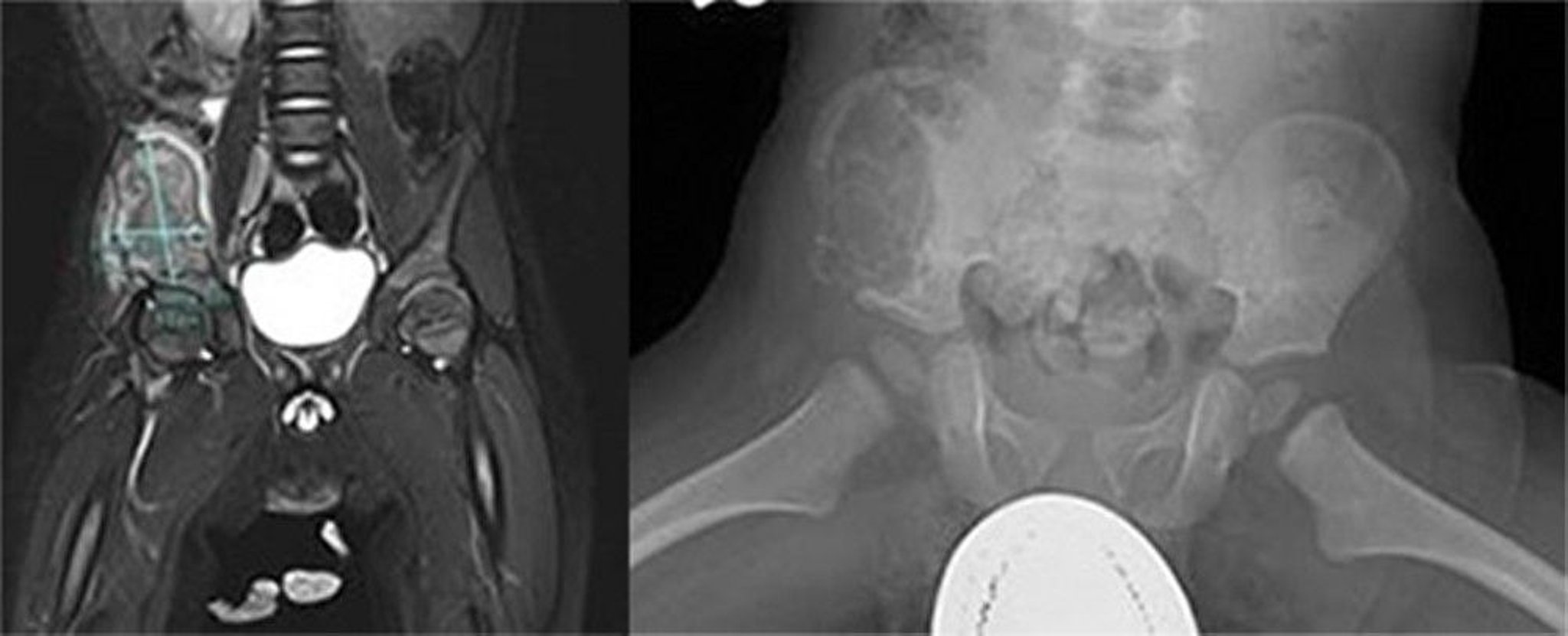 Langerhans Cell Histiocytosis (Pelvic Bone)