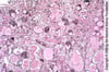 HIV-Associated Nephropathy (Collapsing Glomerulopathy)
