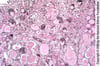Néphropathie associée au VIH (Collapsing Glomerulopathy)