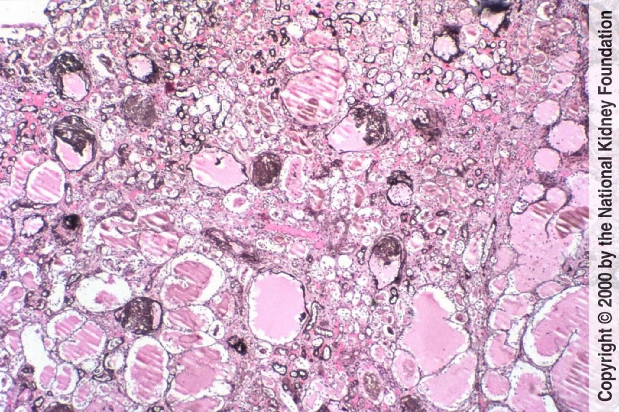 Néphropathie associée au VIH (Collapsing Glomerulopathy)