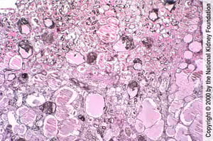 Néphropathie associée au VIH (Collapsing Glomerulopathy)