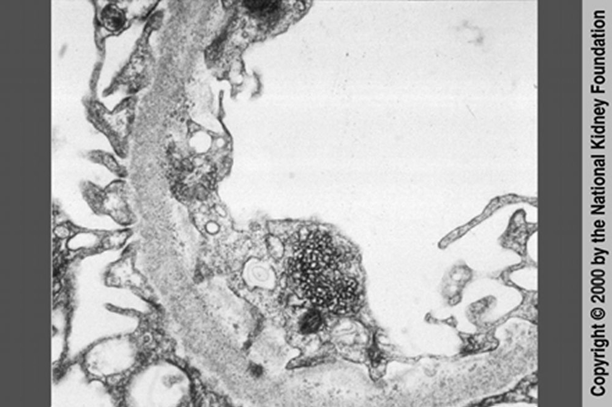 HIV-assoziierte Nephropathie (retikuläre Einschlüsse)