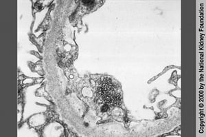 Néphropathie associée au VIH (inclusions réticulaires)