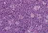 Immunodeficiency-Related Burkitt Lymphoma