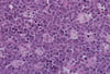Immundefizienzbezogenes Burkitt Lymphom