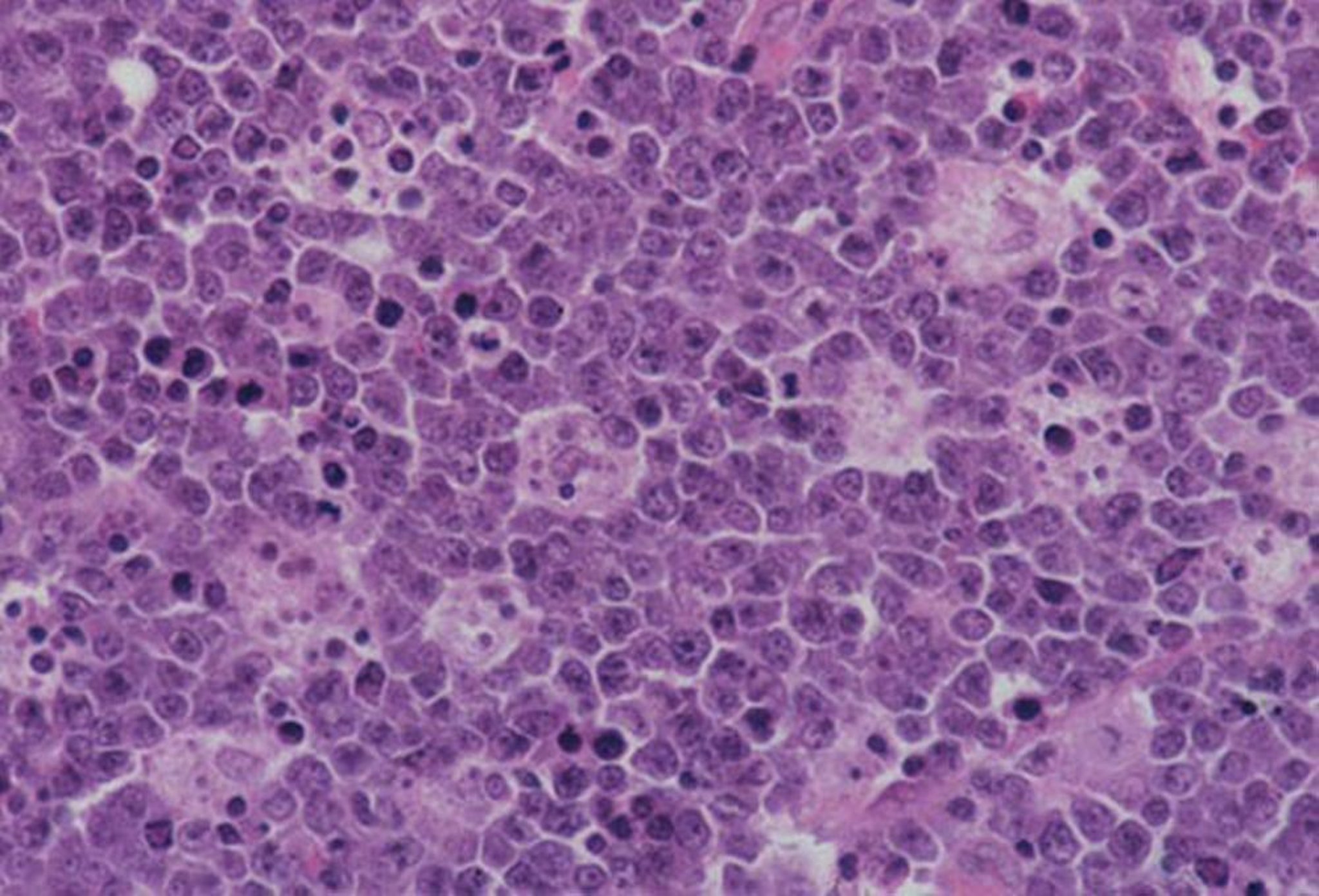 Linfoma di Burkitt correlato con un'immunodeficienza