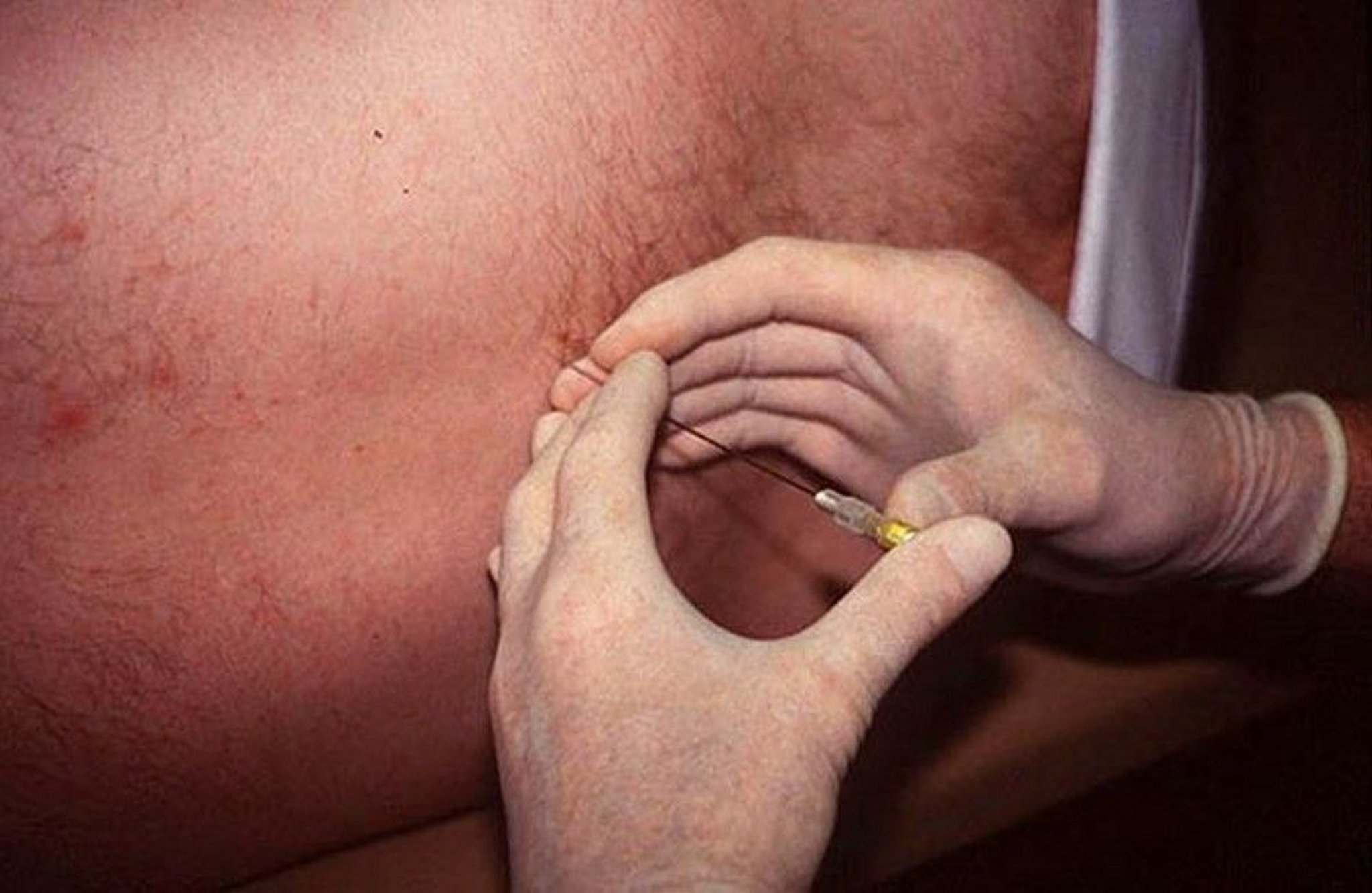 Holding the Lumbar Puncture Needle