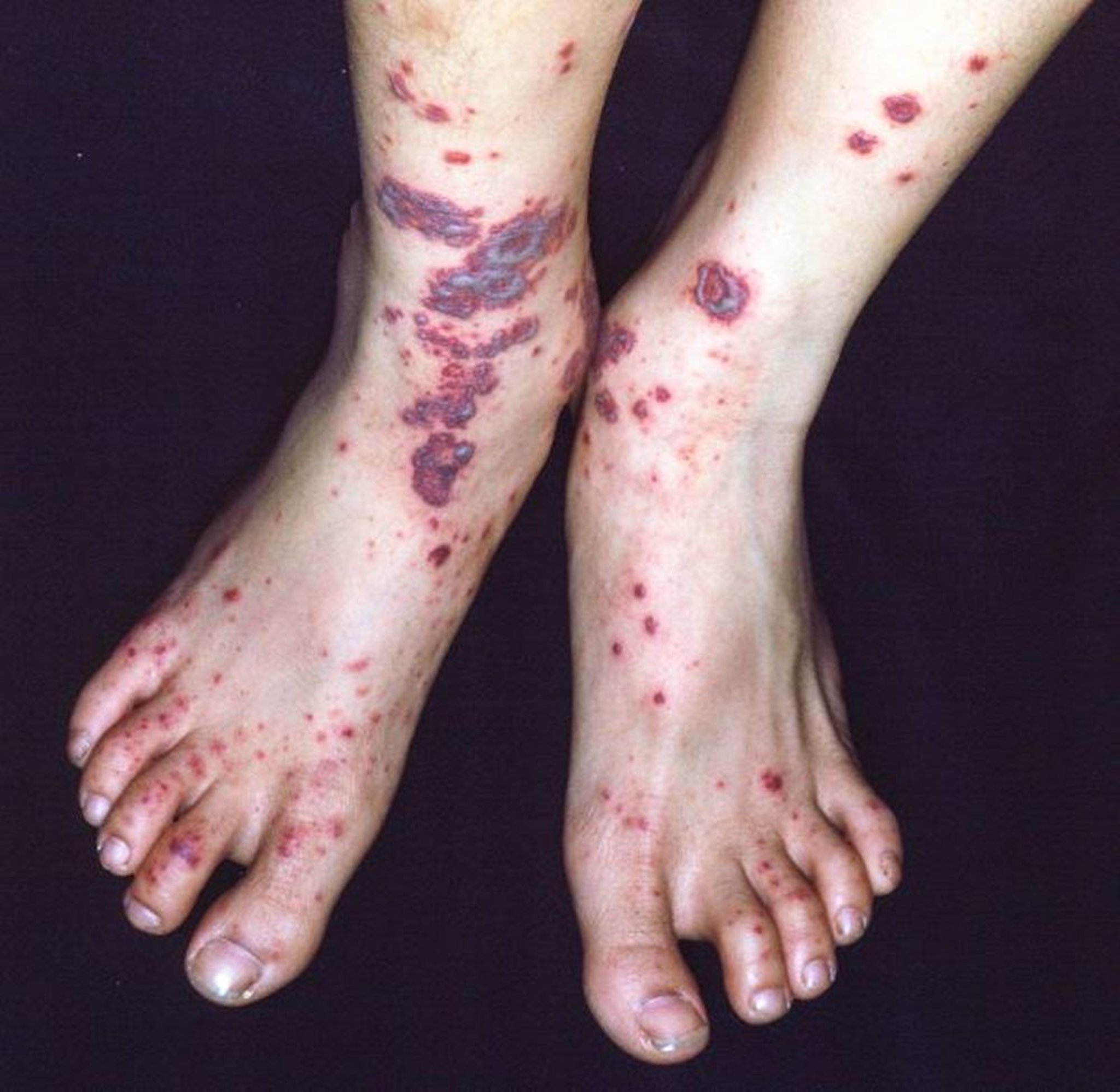 Immunoglobulin-A-Assoziierte Vaskulitis (Hennoch-Schönlein-Purpura) (Füße)