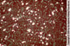 Hiperoxaluria
