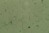 Hyphae and Spores in Candidal Vaginitis