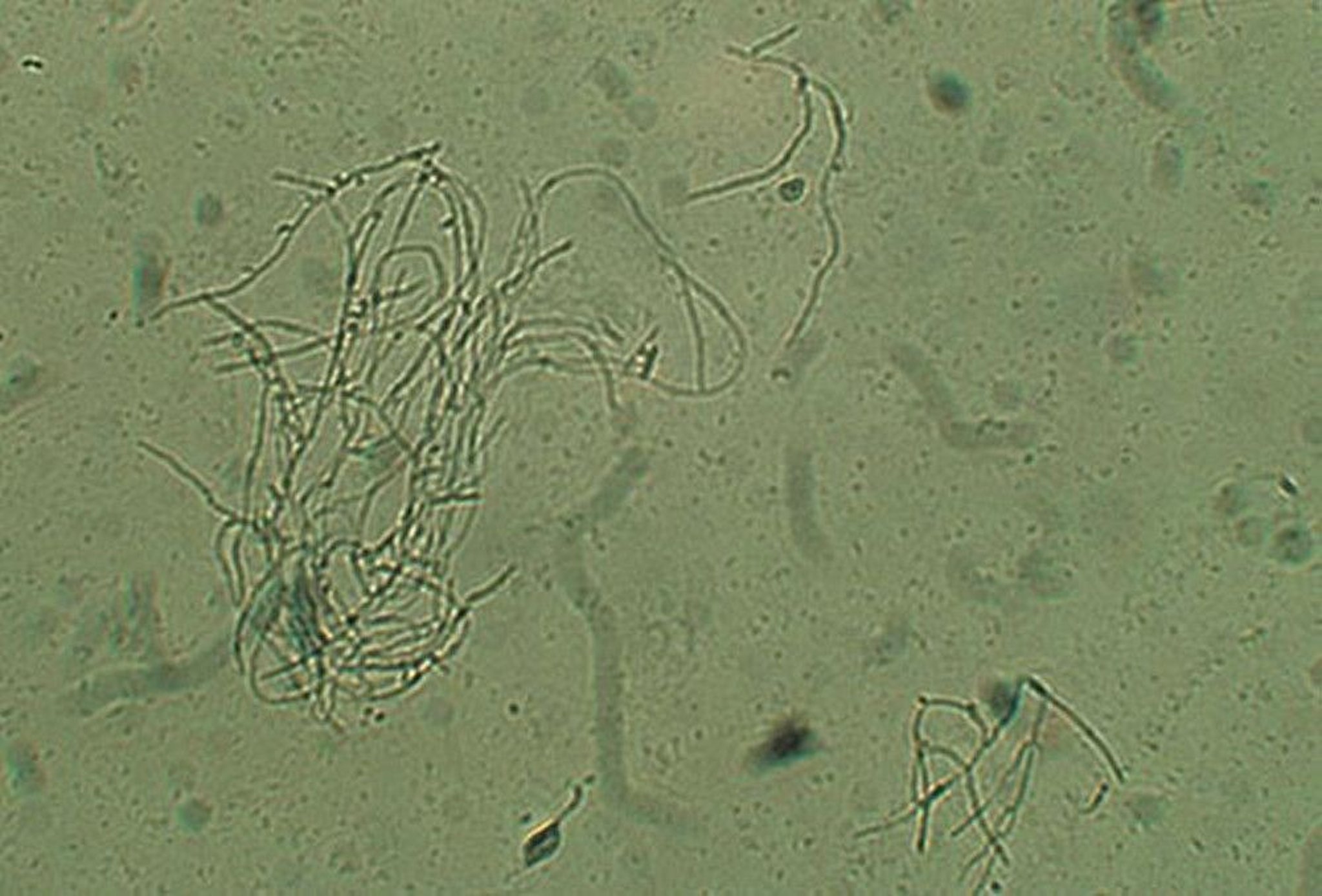 Hyphae and Spores in Candidal Vaginitis