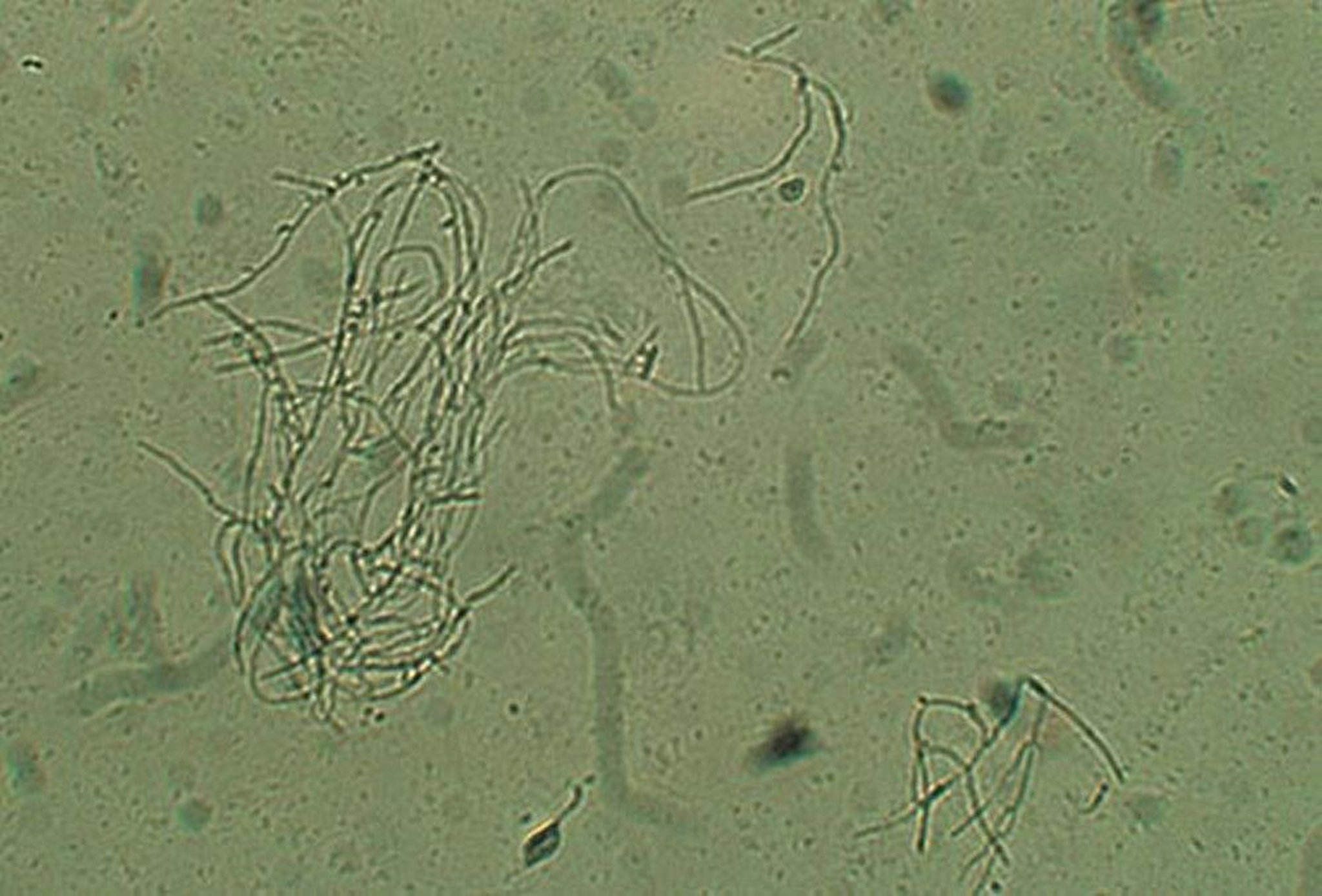 Hyphae and Spores in Candidal Vaginitis