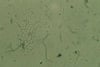 Hyphes et spores dans la vaginite candidosique