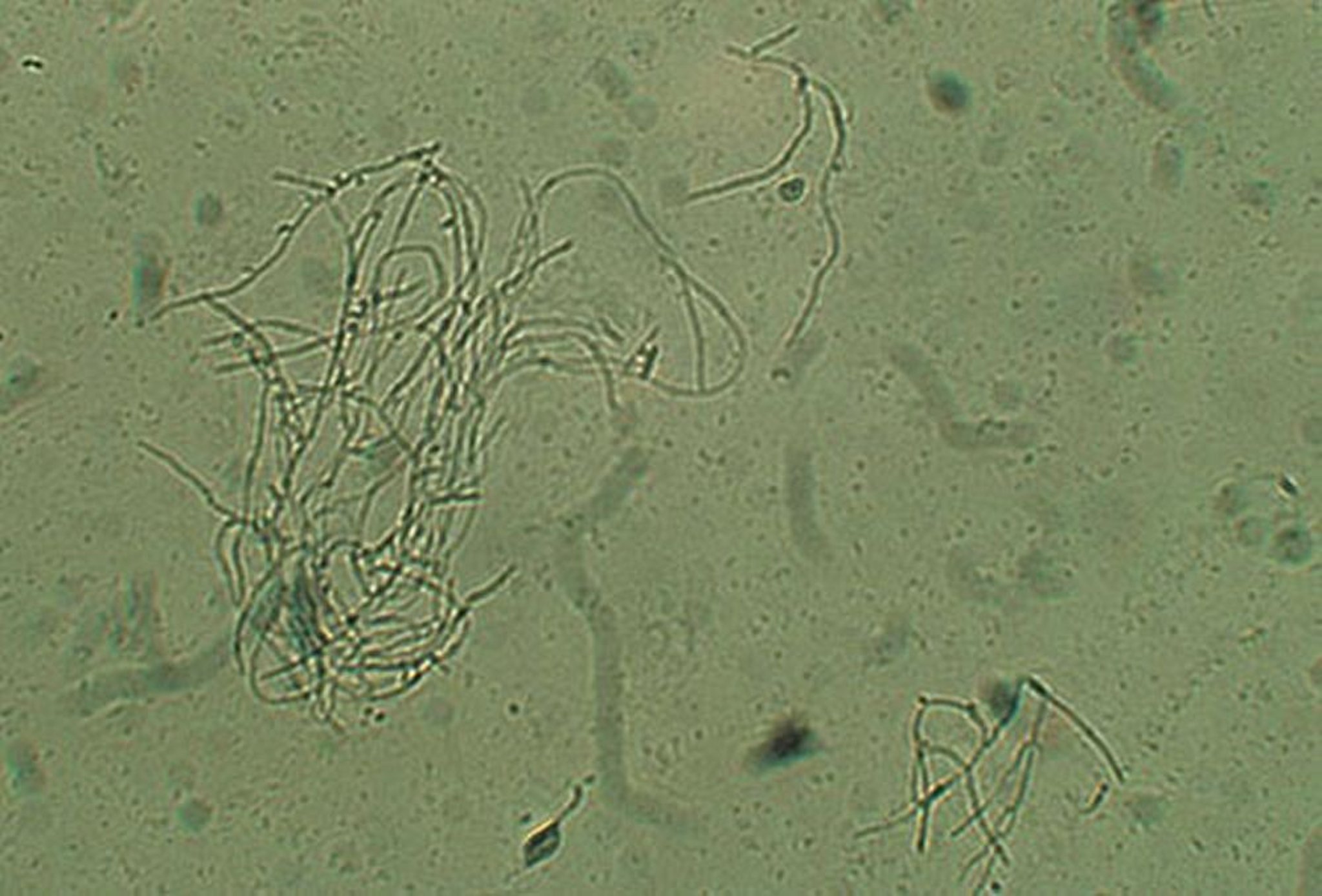 Hyphes et spores dans la vaginite candidosique