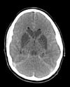 Lesão encefálica isquêmica hipóxica e edema cerebral