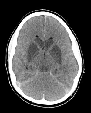Lesão cerebral isquêmica hipóxica e edema cerebral