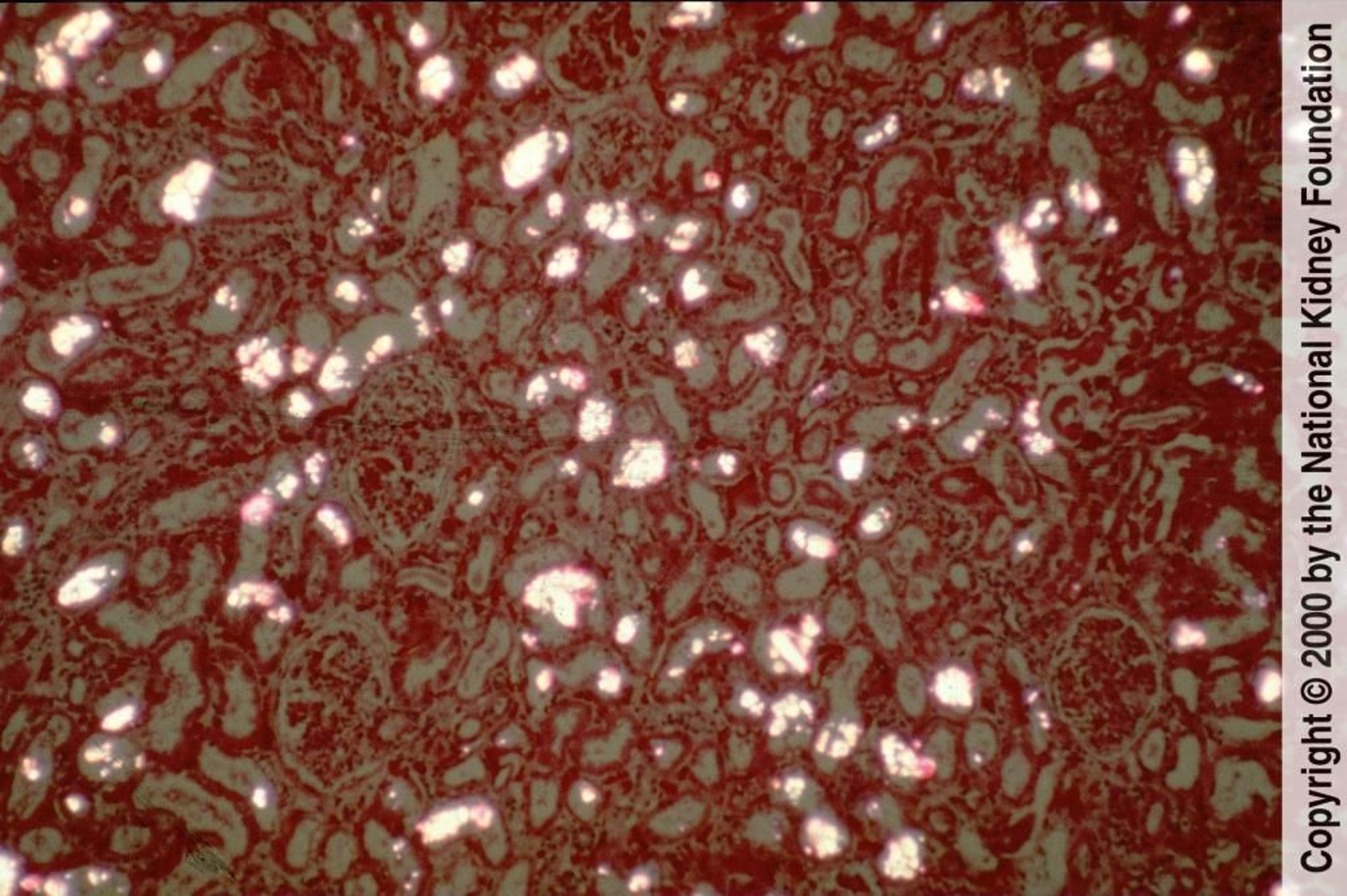 Гіпероксалурія