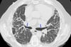 Chronic Hypersensitivity Pneumonitis