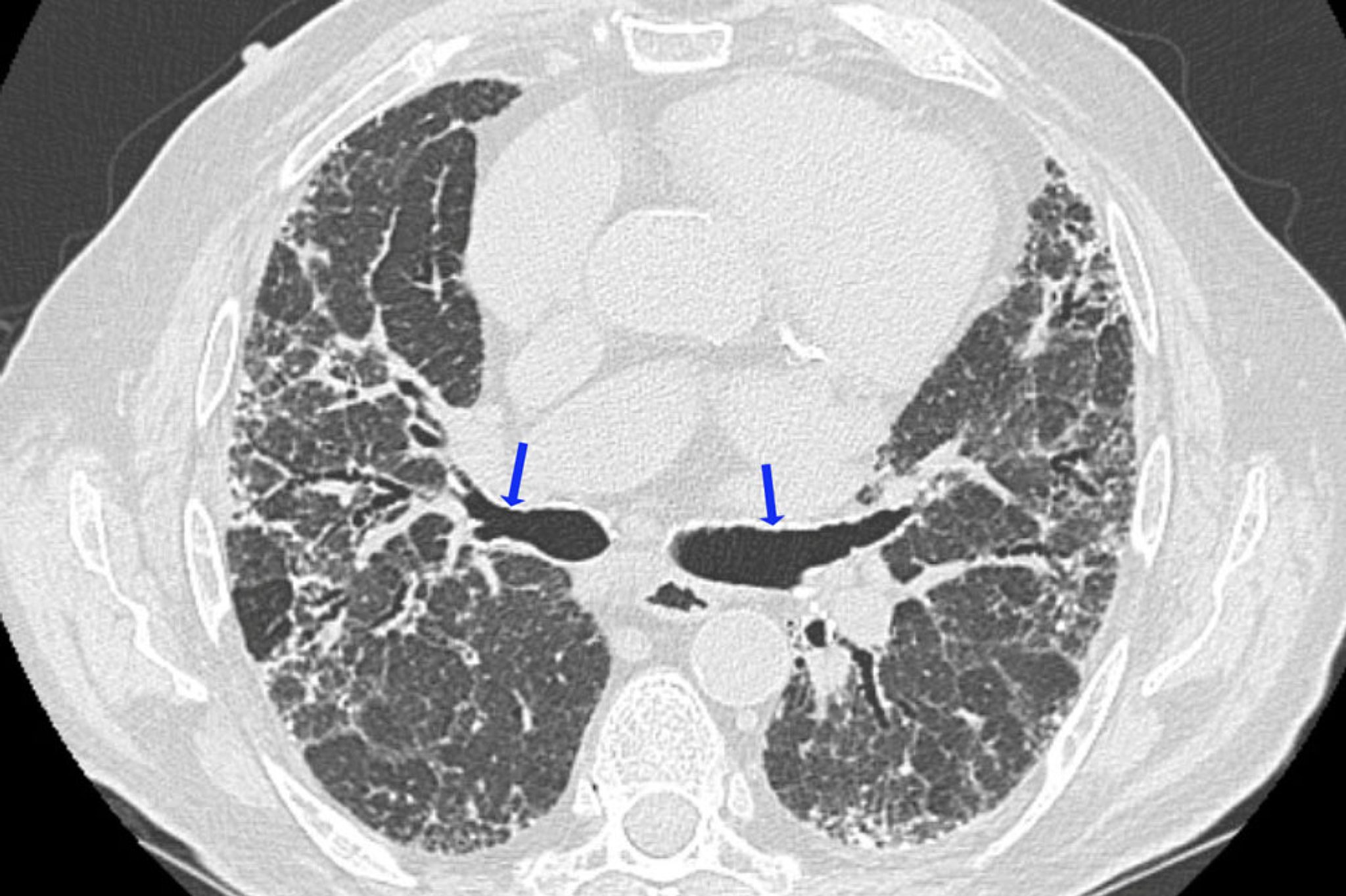 Neumonitis crónica por hipersensibilidad
