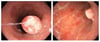 Giả polyp