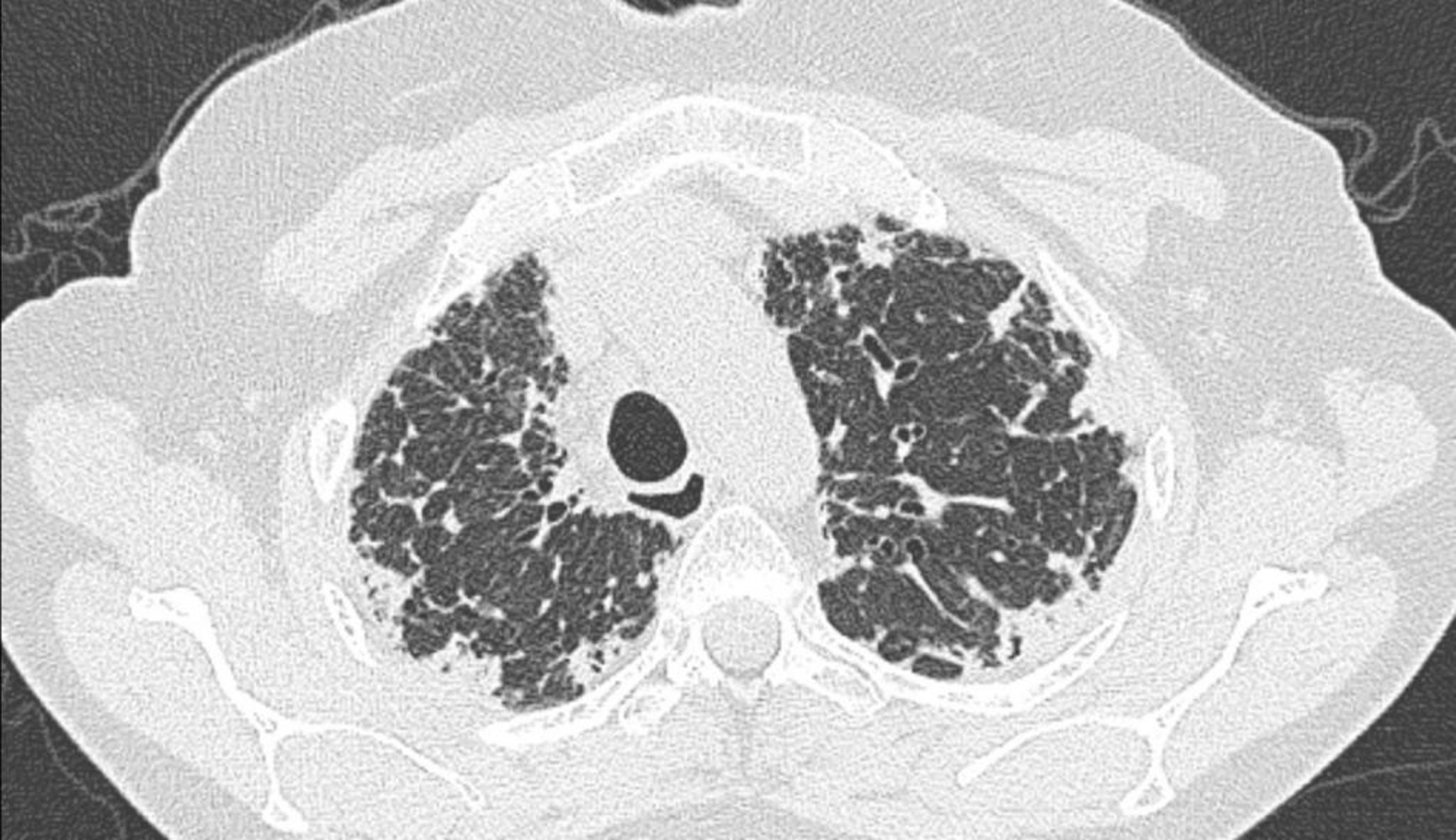 Idiopathic Pleuroparenchymal Fibroelastosis (CT Scan)