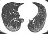 Polmonite interstiziale aspecifica idiopatica