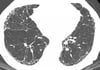 Fibrosis pulmonar idiopática
