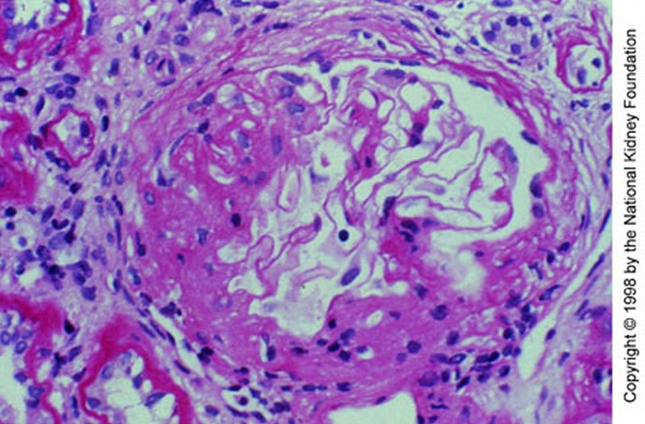 IgA Nephropathy (Mesangial Expansion)