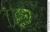 IgA Nephropathy (Mesangial IgA Deposition)