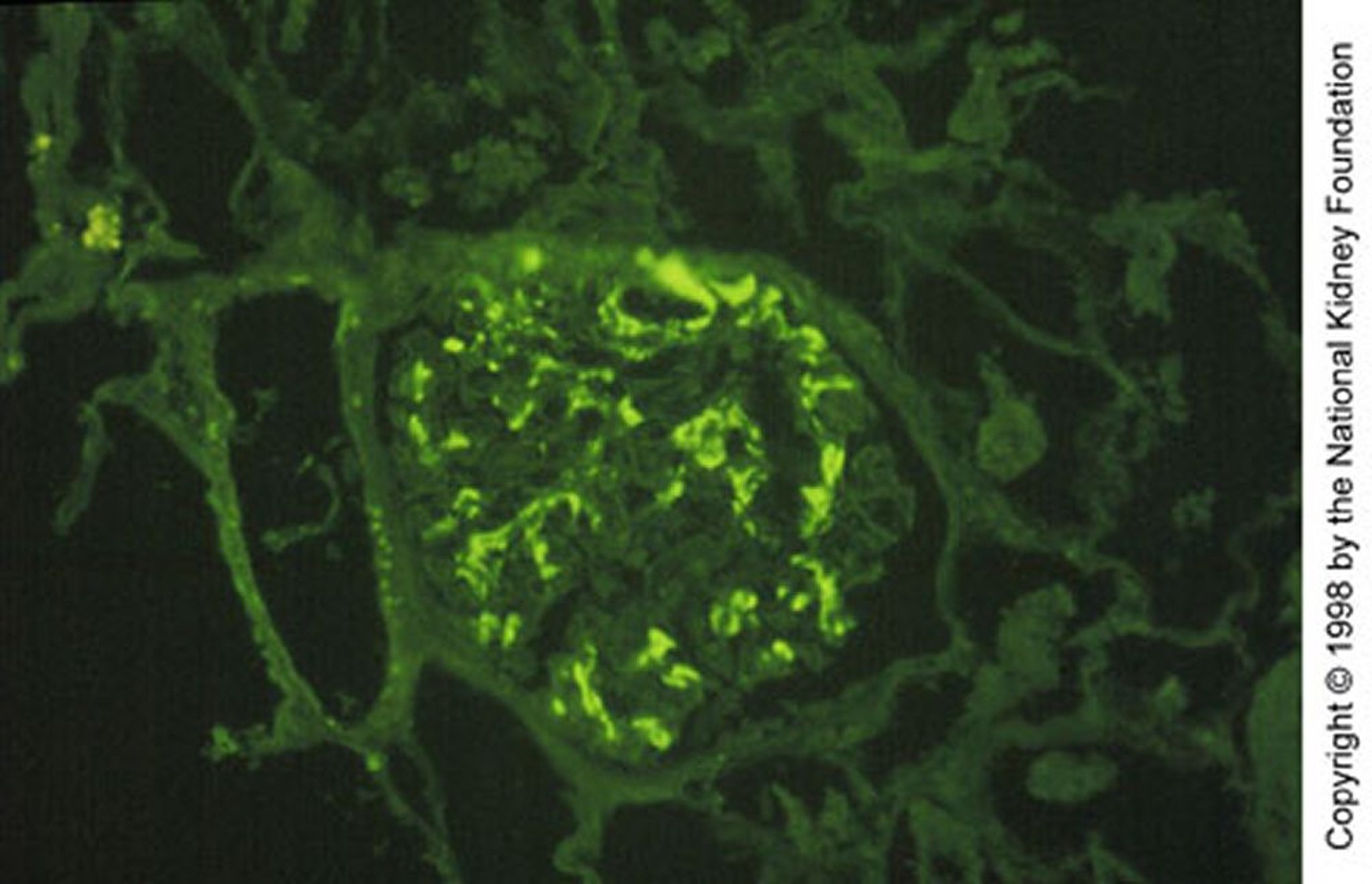 IgA-Nephropathie (mesangiale IgA-Ablagerung)