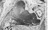Glomérulopathie immunotactoïde