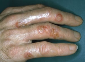 水疱性膿痂疹（指）
