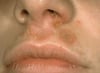 Nonbullous Impetigo