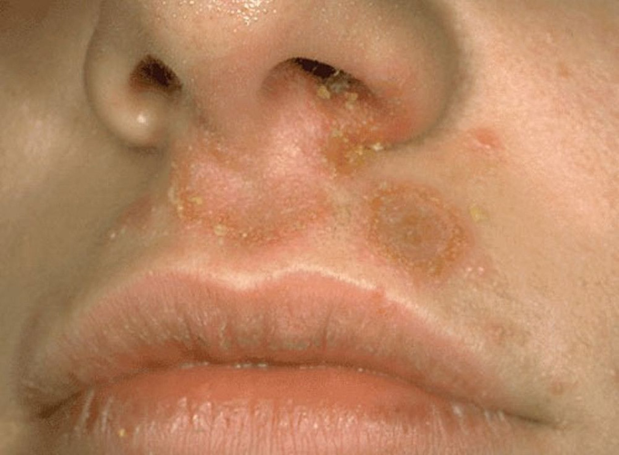 Nonbullous Impetigo