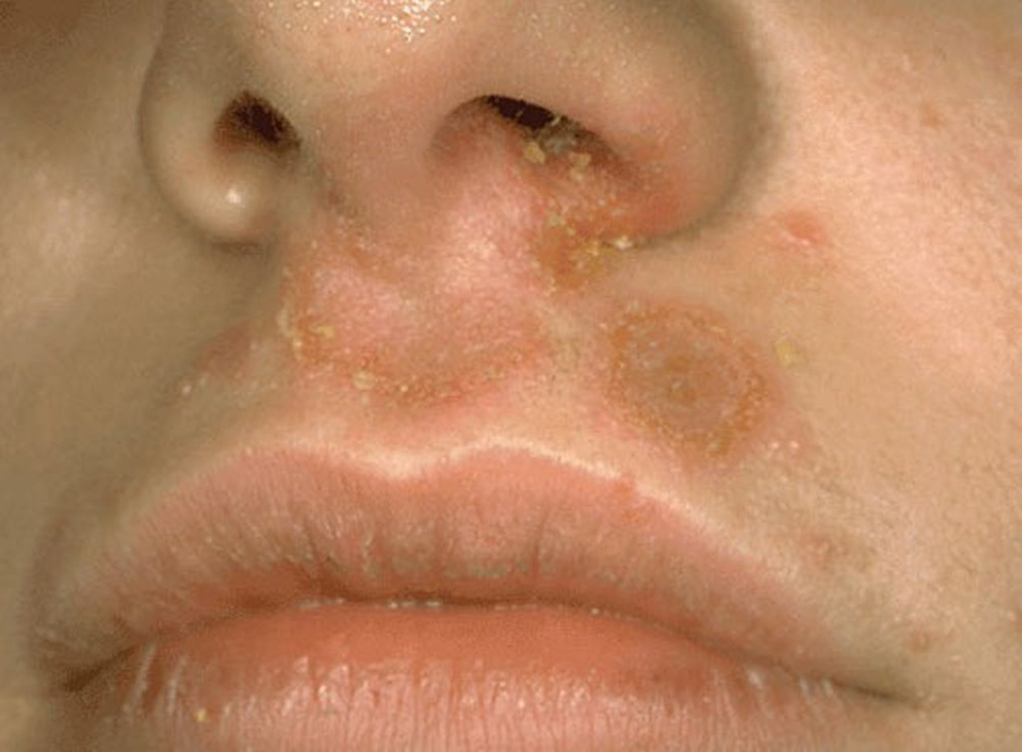 Impetigo não bolhoso