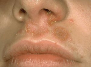 Chốc lở không bọng nước