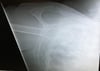Inferior Shoulder Dislocation