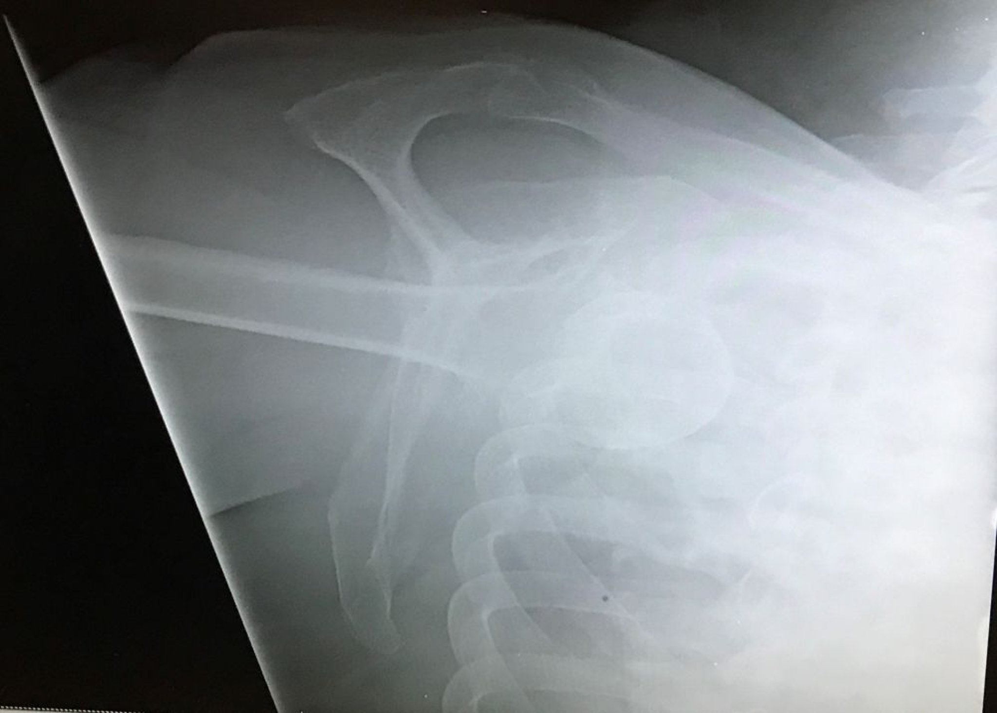 Inferiore Schulterluxation