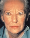 浸潤性眼症（infiltrative ophthalmopathy）