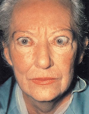 Infiltrative Ophthalmopathy in Graves Disease