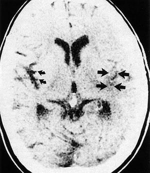 Insular Ribbon Loss
