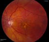 Degenerazione maculare legata all'età (secca, intermedia)